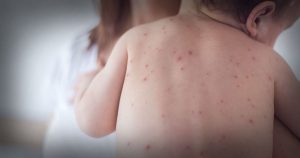Waspadai Gejala Campak pada Anak Kenali Tanda Khasnya Sejak Dini